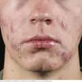 Acne pimple-acnepimple.no1